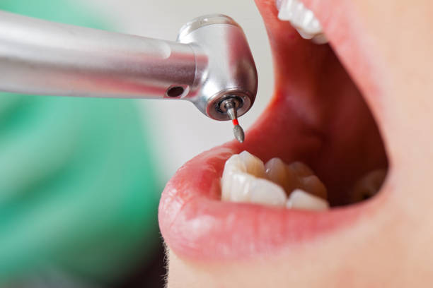 Best Broken or Chipped Tooth Repair in Greentown, OH